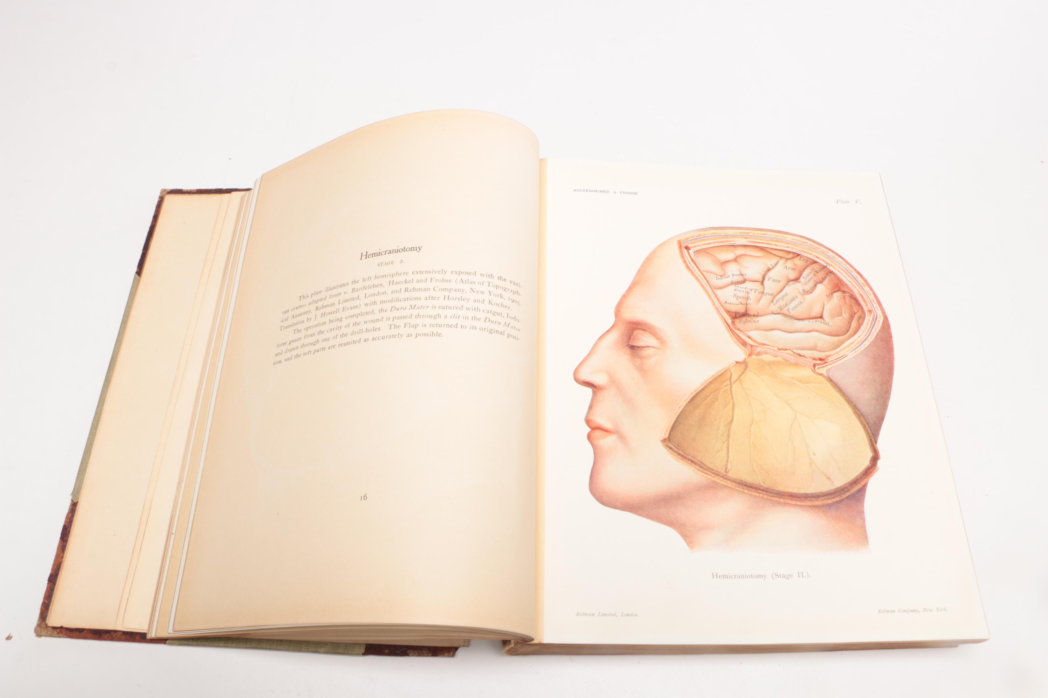 1906 "Atlas of Typical Operations in Surgery" by Bockenheimer and Frohse