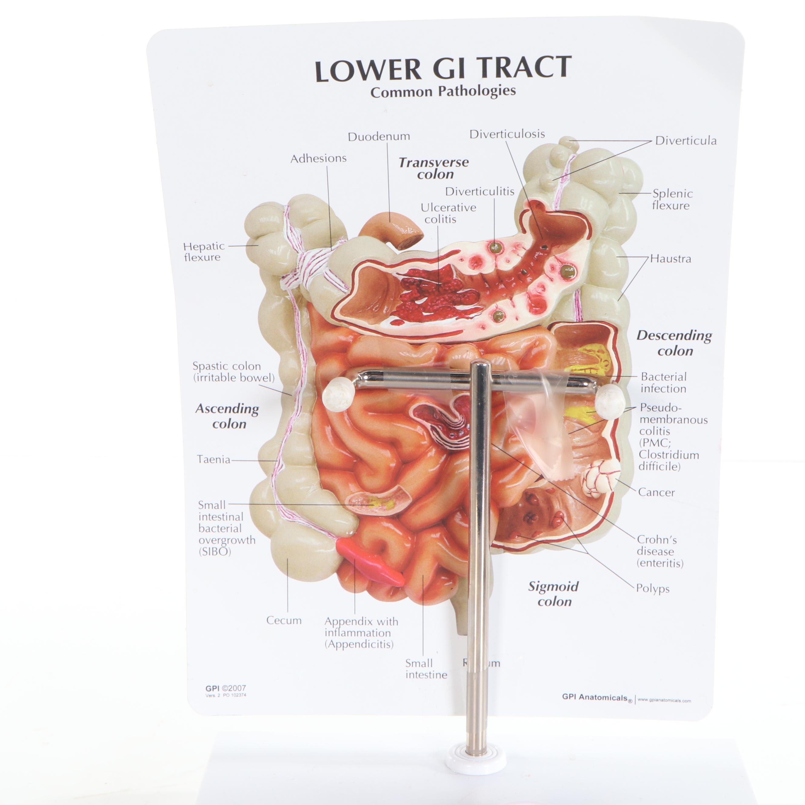 GPI Anatomicals Lower Gastrointestinal Tract Common Pathologies Model