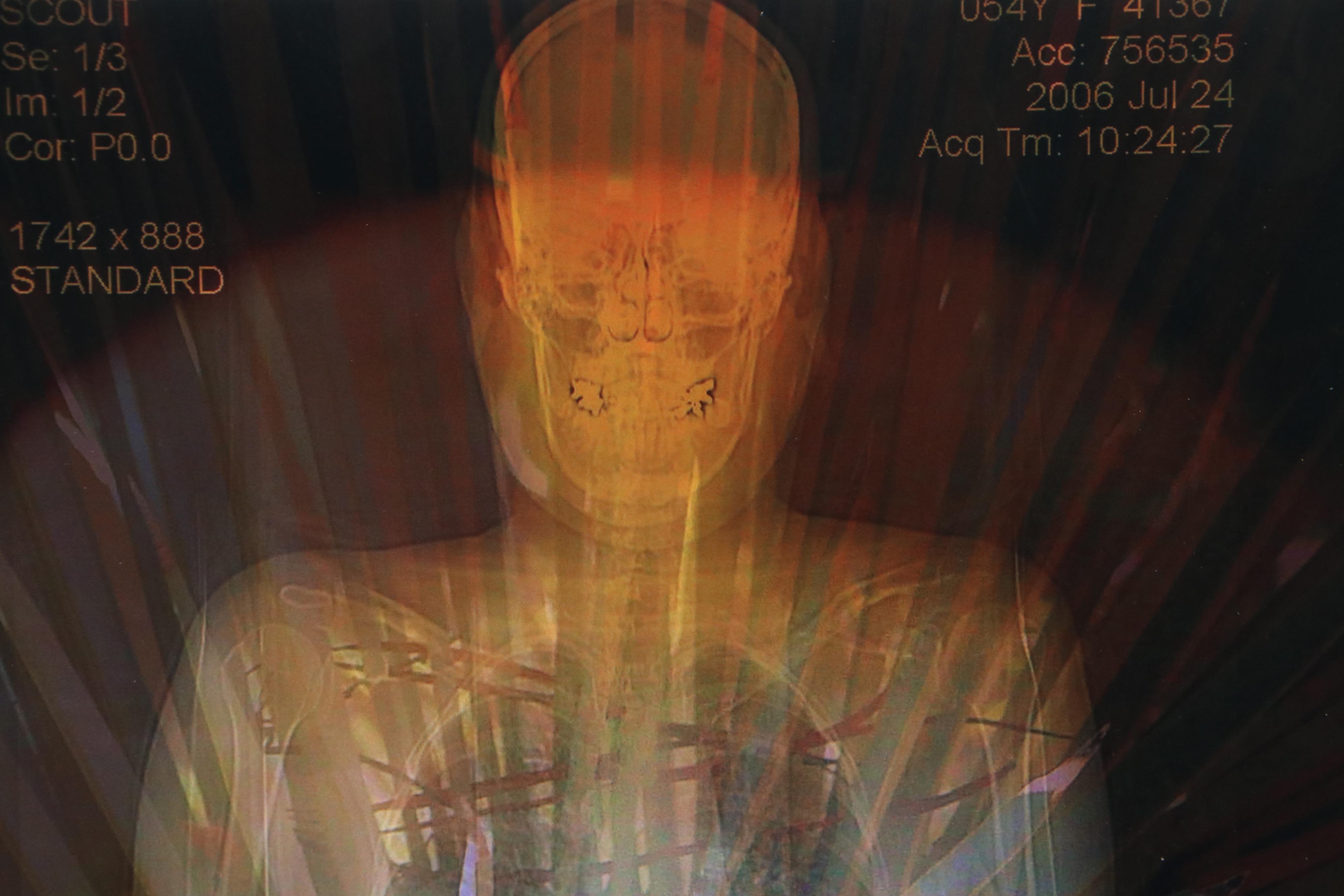 Sarah Roush Digital Collages "Ted's Eye," Late 20th Century