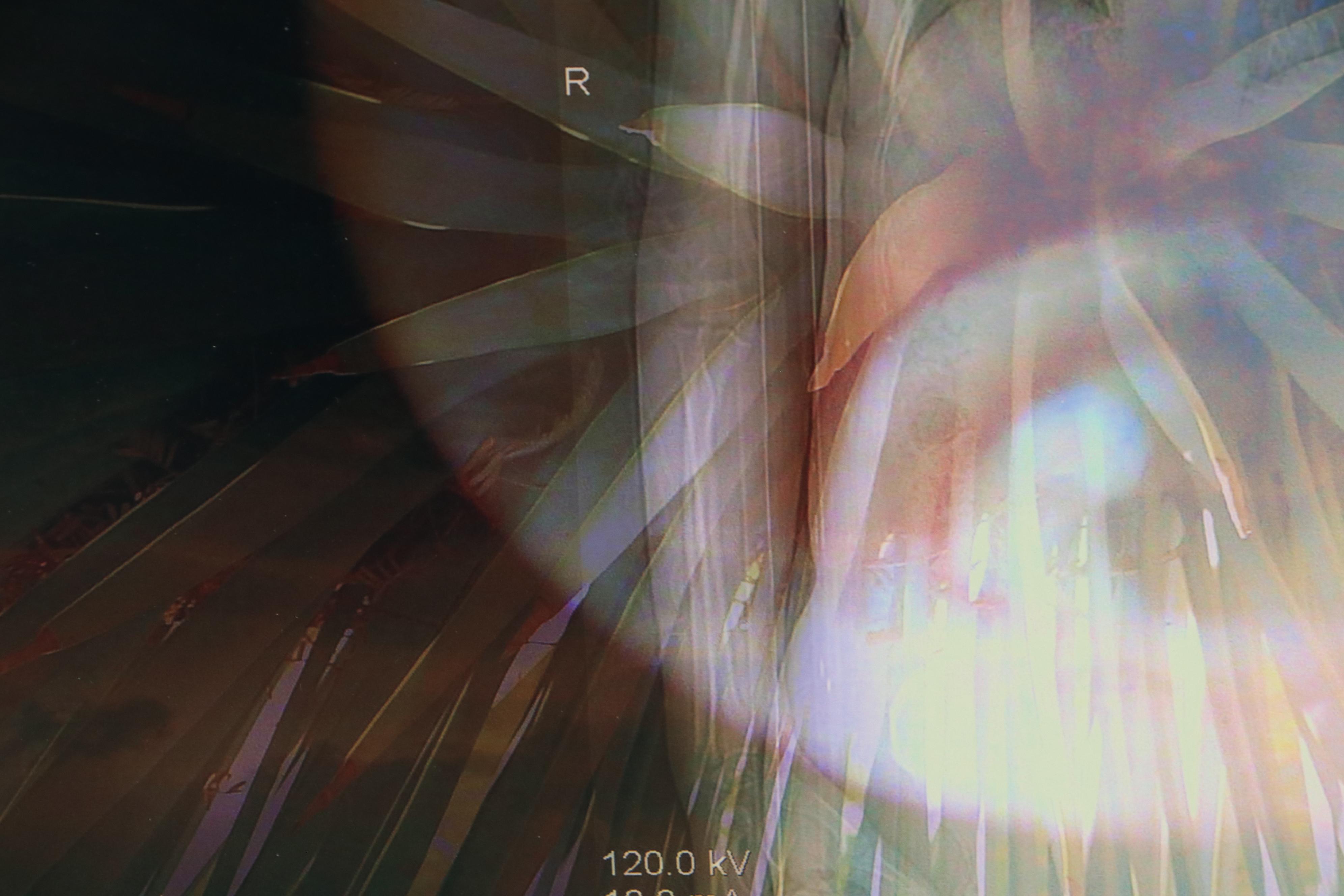 Sarah Roush Digital Collages "Ted's Eye," Late 20th Century