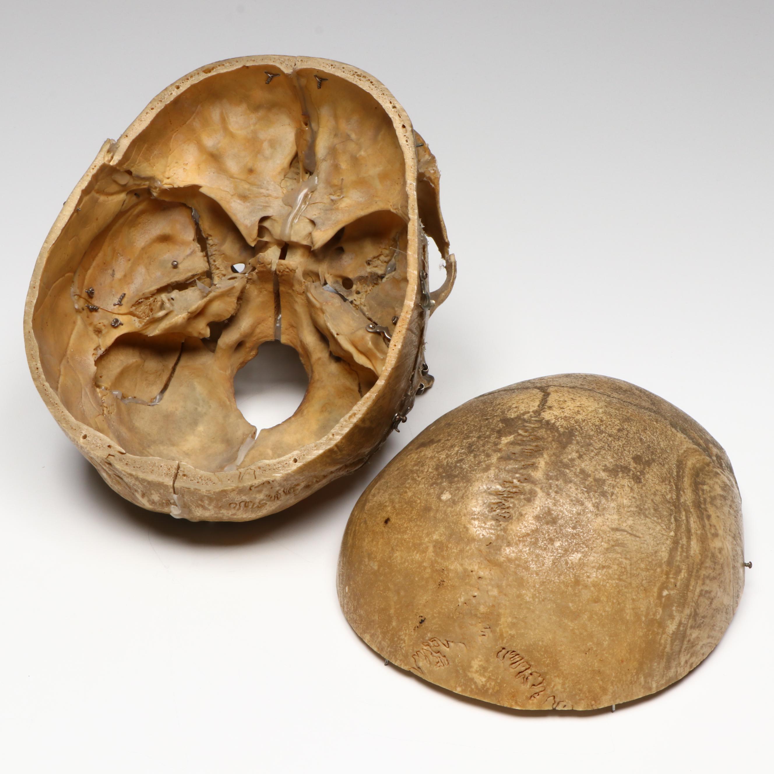 Human Skull Medical Specimen with Leather Doctor's Bag, 20th Century