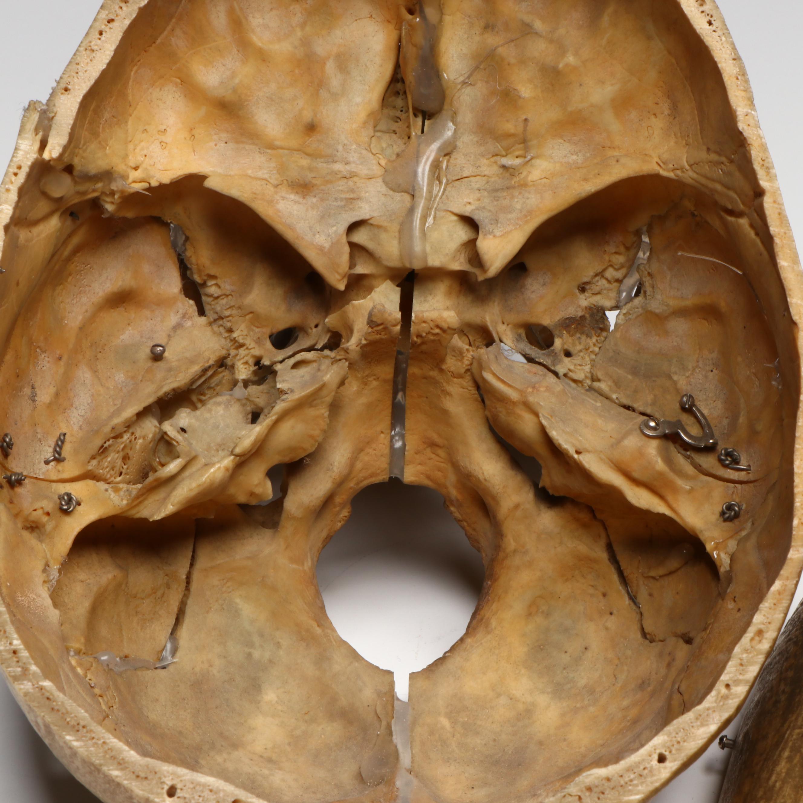 Human Skull Medical Specimen with Leather Doctor's Bag, 20th Century