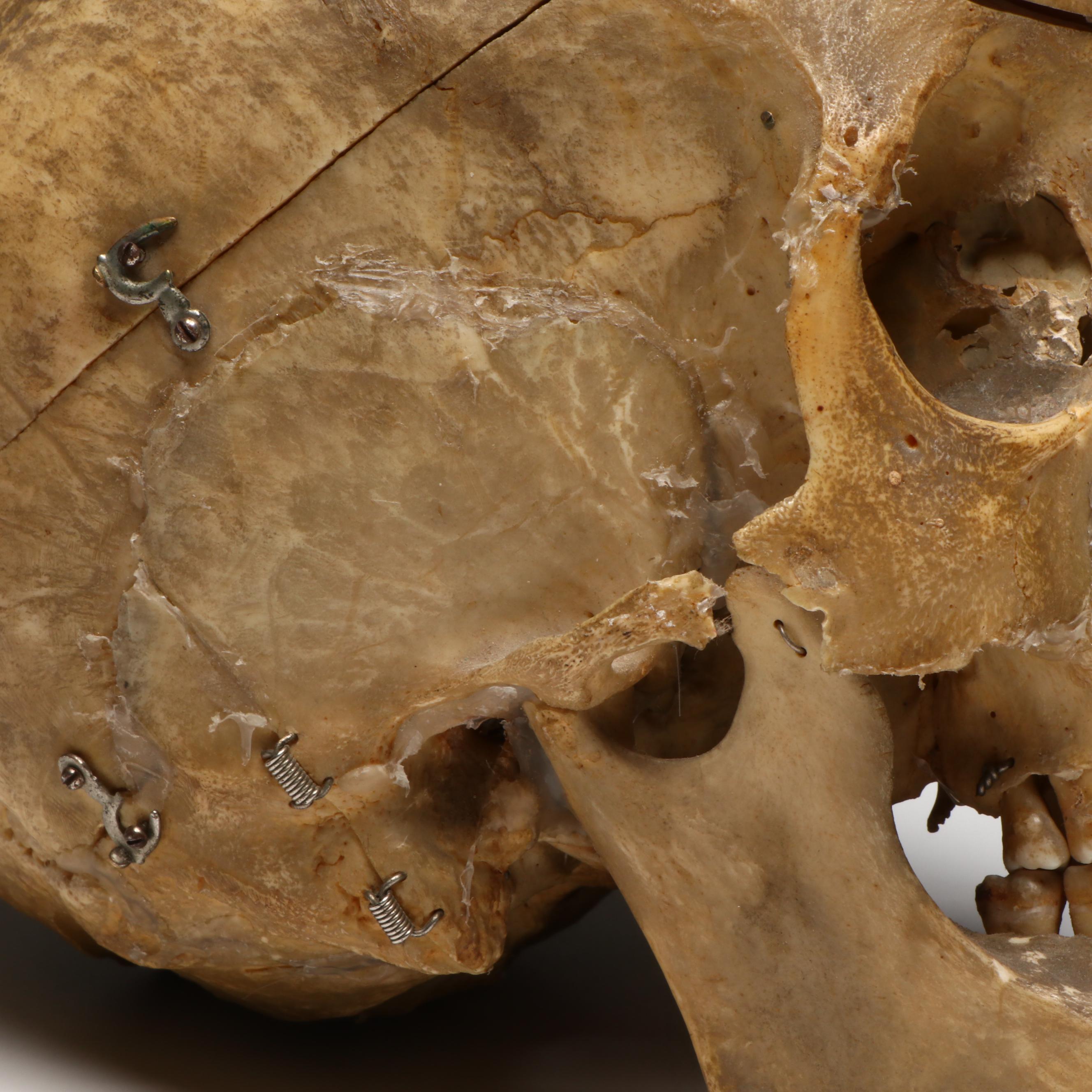 Human Skull Medical Specimen with Leather Doctor's Bag, 20th Century