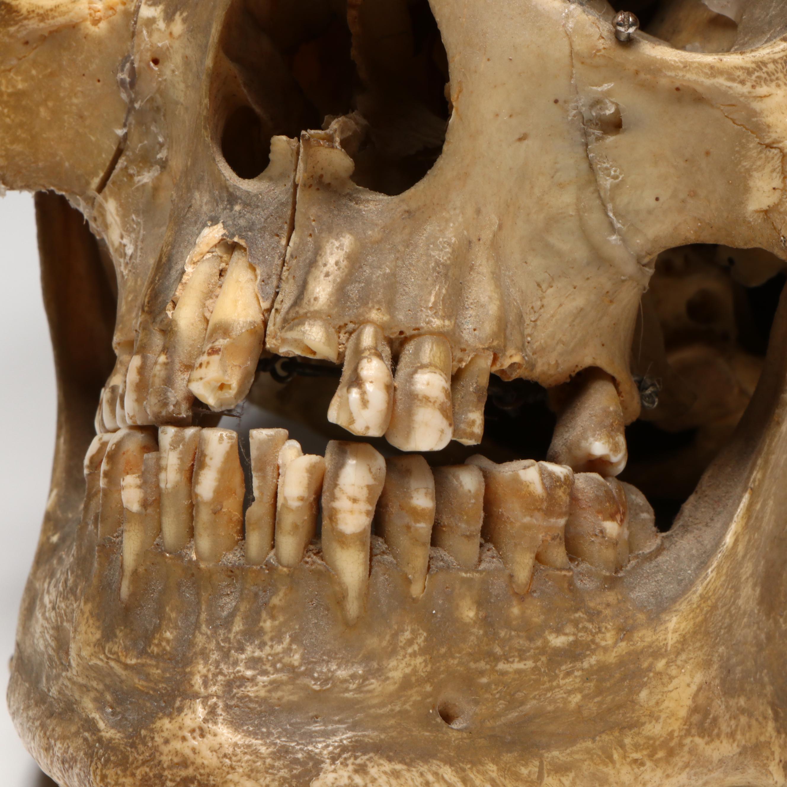 Human Skull Medical Specimen with Leather Doctor's Bag, 20th Century