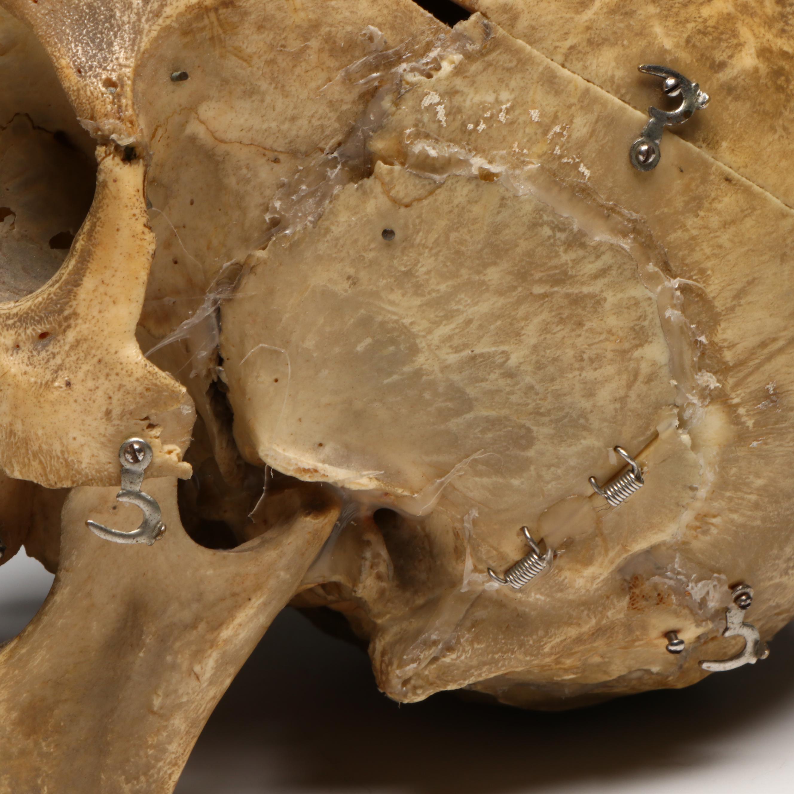 Human Skull Medical Specimen with Leather Doctor's Bag, 20th Century