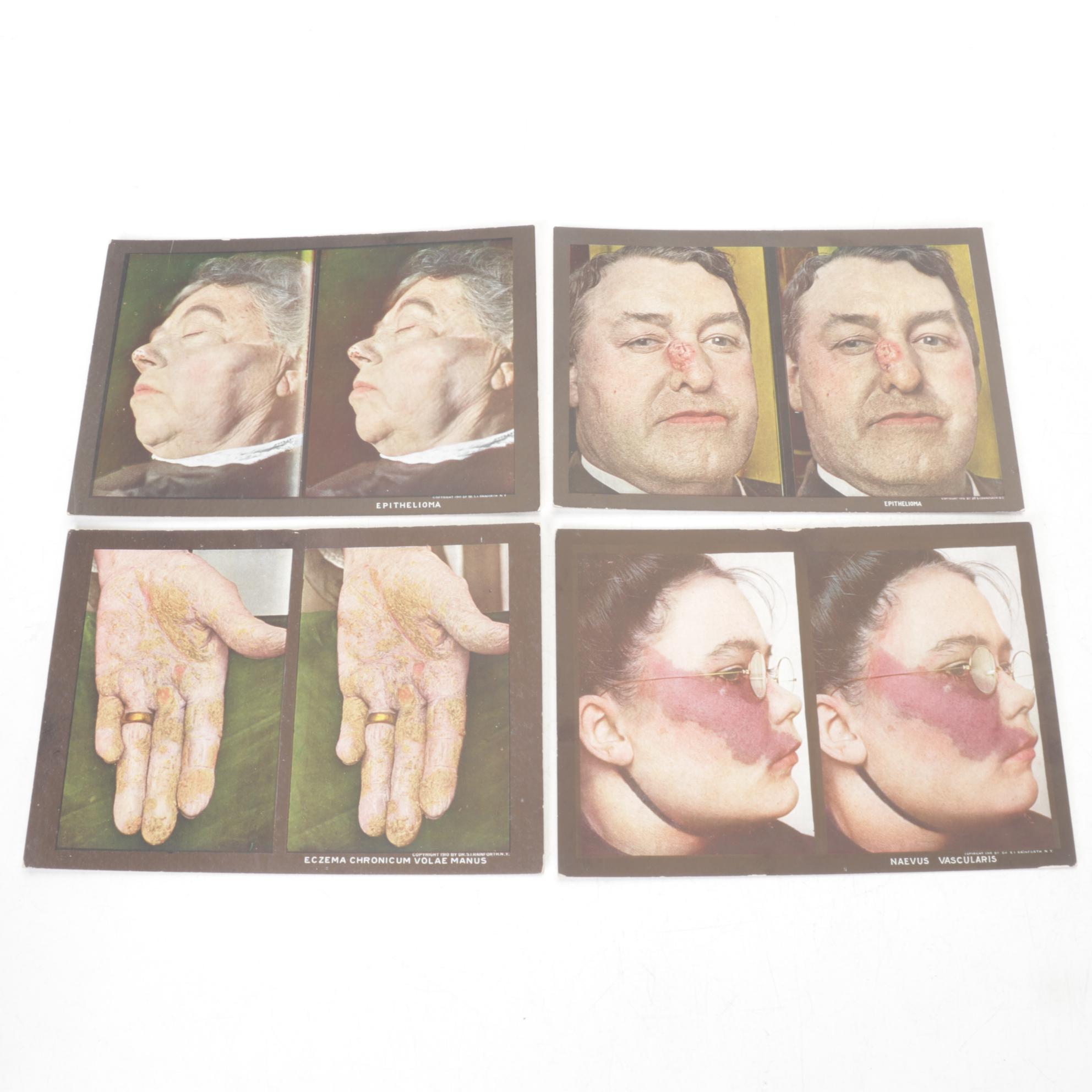 Stereoscopic Skin Clinic Set of Stereoscope and Medical Slides, 1914