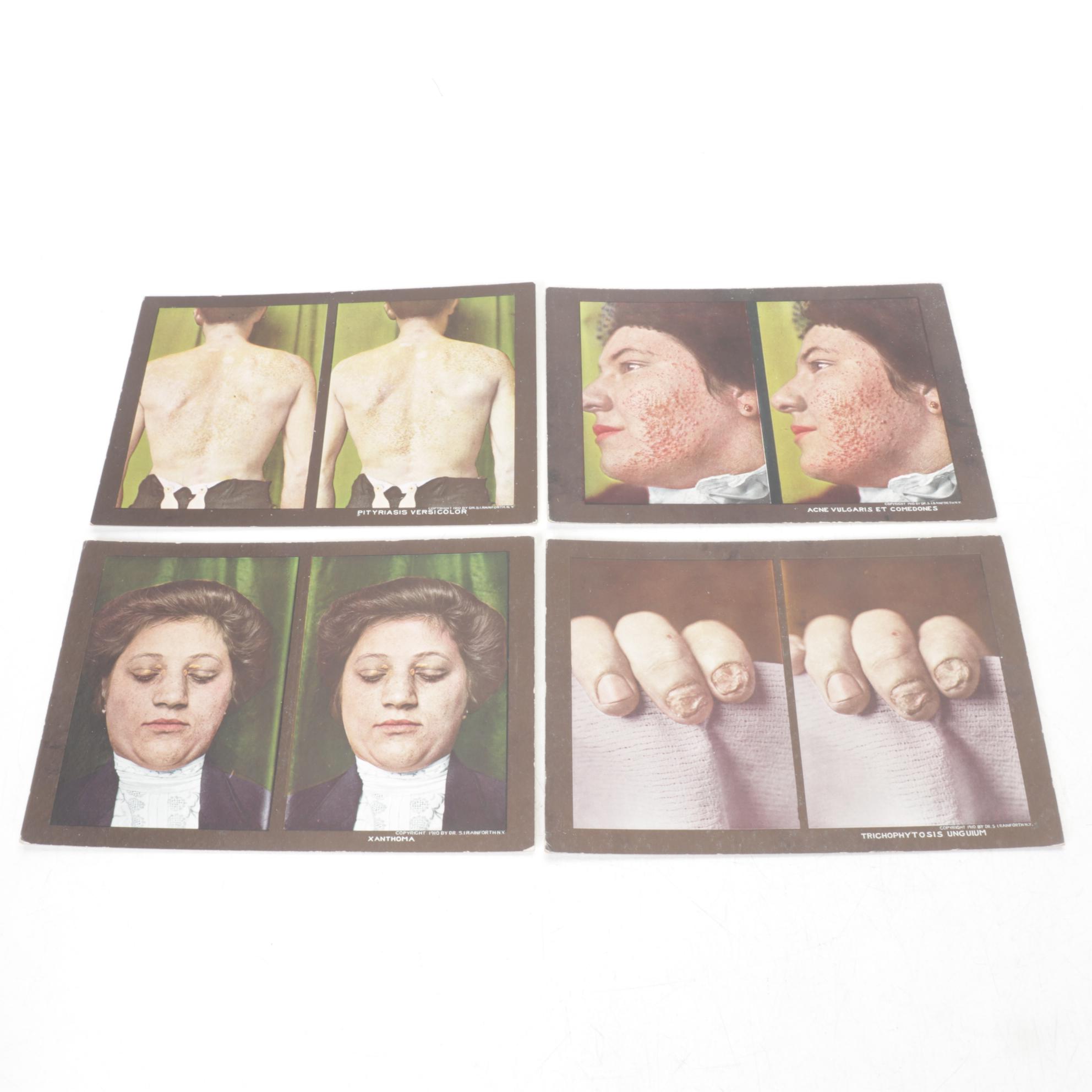 Stereoscopic Skin Clinic Set of Stereoscope and Medical Slides, 1914