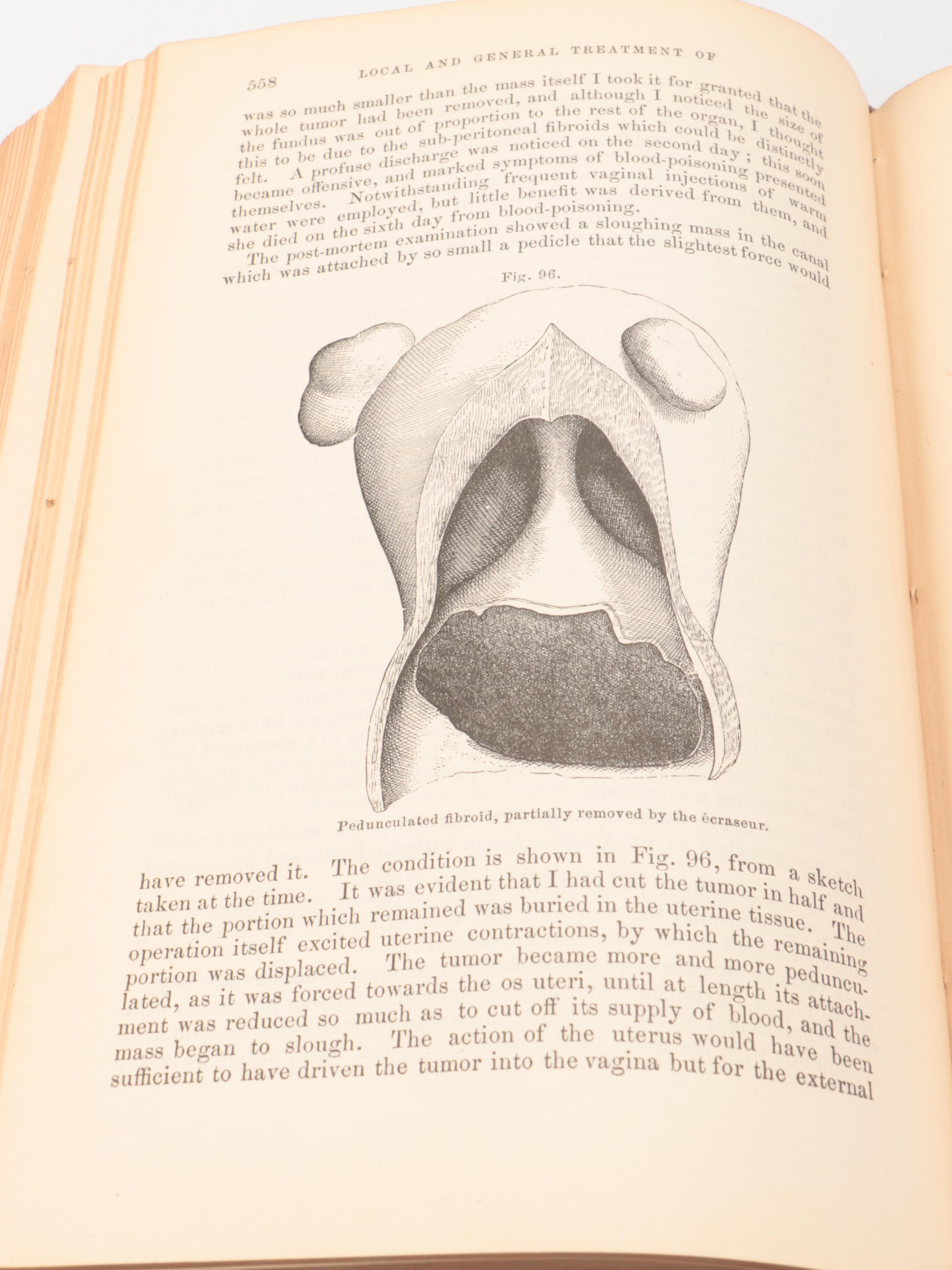 "The Principles and Practice of Gynæcology" by Thomas Addis Emmet, 1879